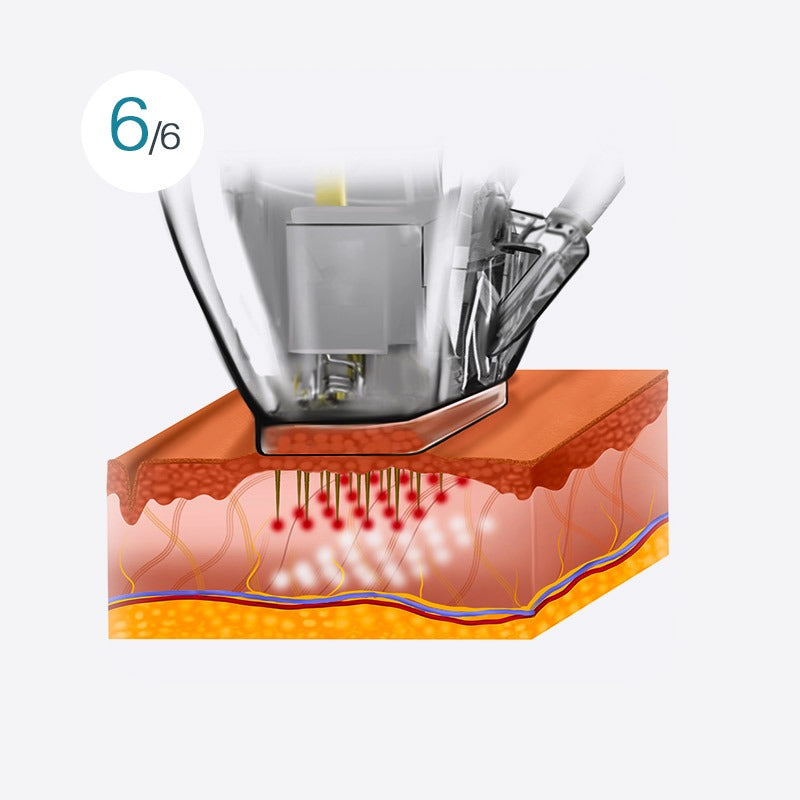 [Microneedle & Radio Frequency] ELLISYS SENSE