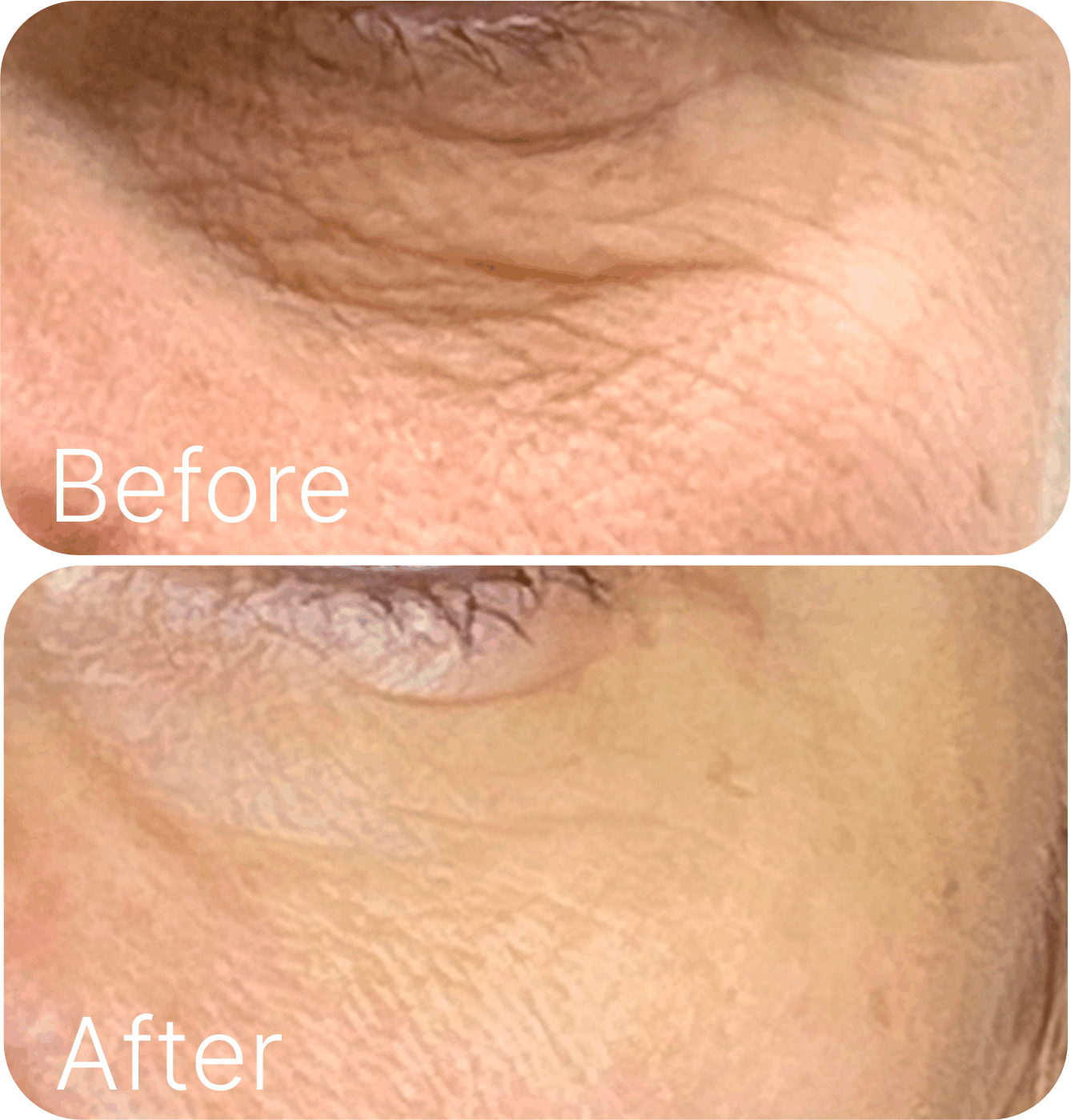 [Microneedle & Radio Frequency] ELLISYS SENSE